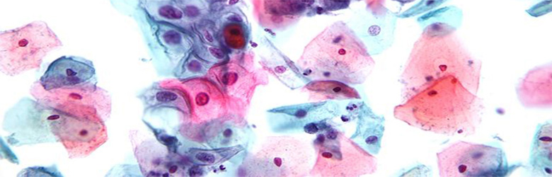 ¿Por qué las mujeres no se hacen el examen Papanicolaou?