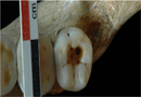 Una caries de 14 mil años...correctamente tratada