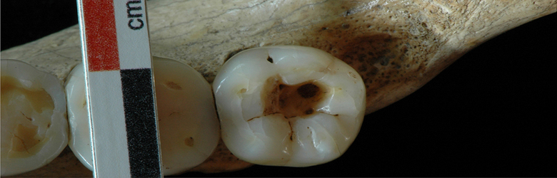 Una caries de 14 mil años...correctamente tratada