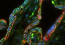 Preeclampsia: investigación busca dar con el origen celular en el desarrollo de la enfermedad