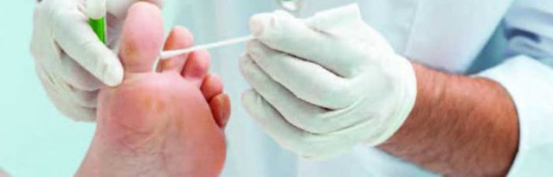 Infecciones por hongos, las molestias del verano